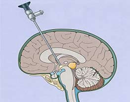 Neuroendoscopy